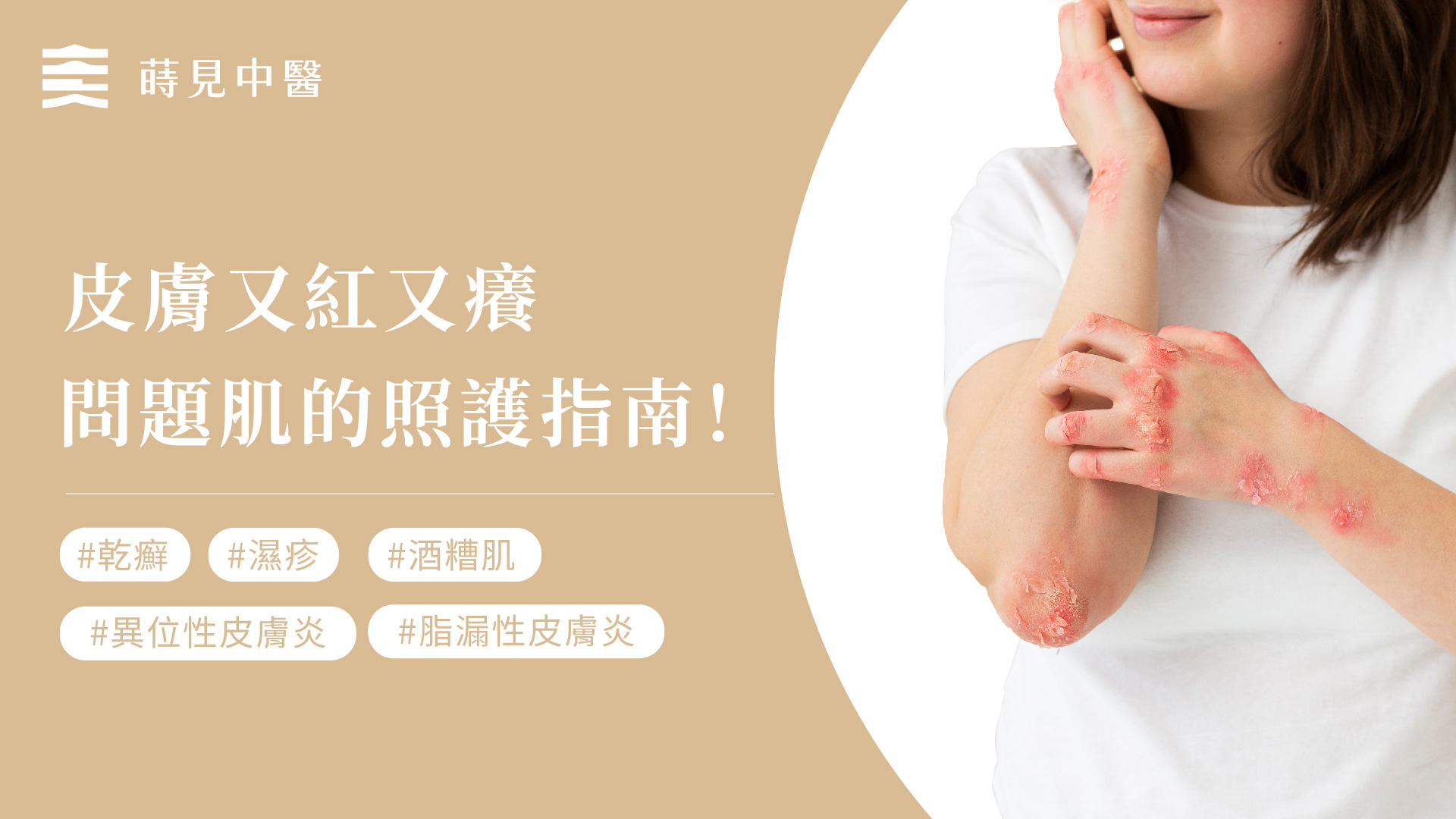 濕疹、異位性皮膚炎、乾癬、脂漏的中醫照護指南！ – 蒔見中醫