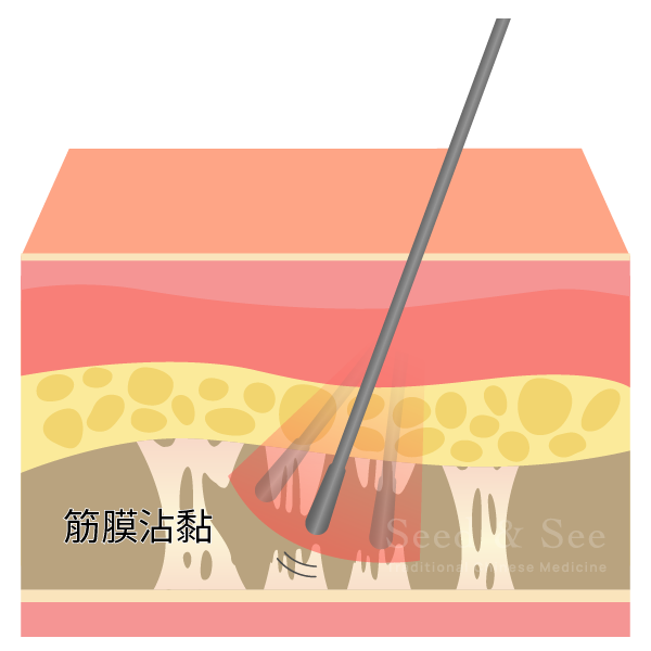 蒔特色醫療 - 小針刀 – 蒔見中醫