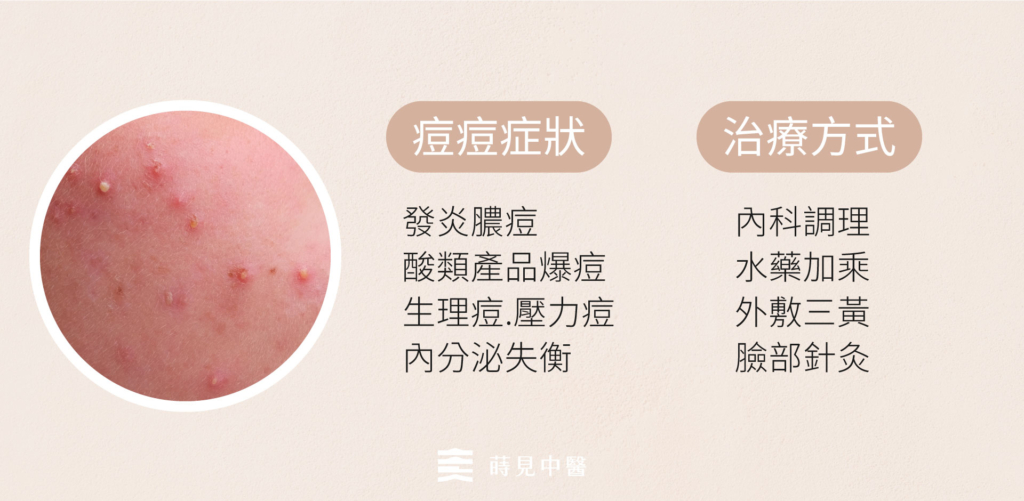 痘痘治療階段一