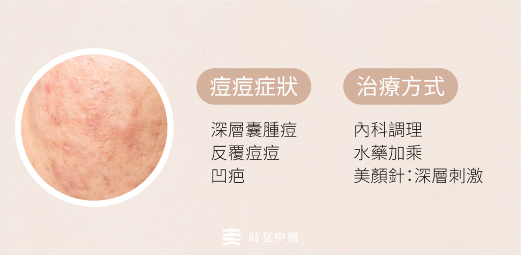 痘痘治療階段二