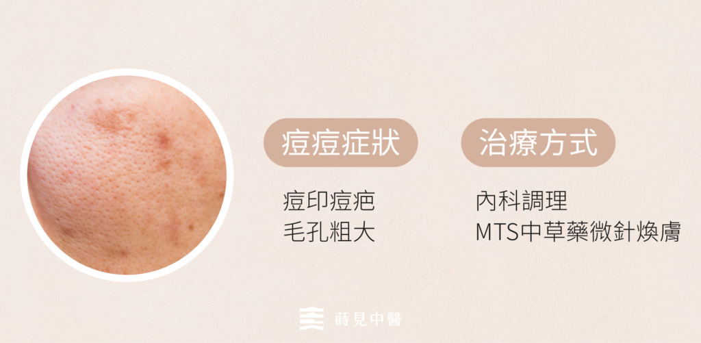 痘痘治療階段三