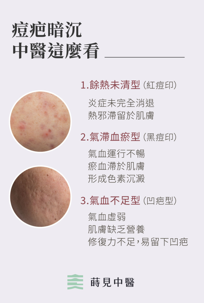 中醫治療痘疤暗沉
