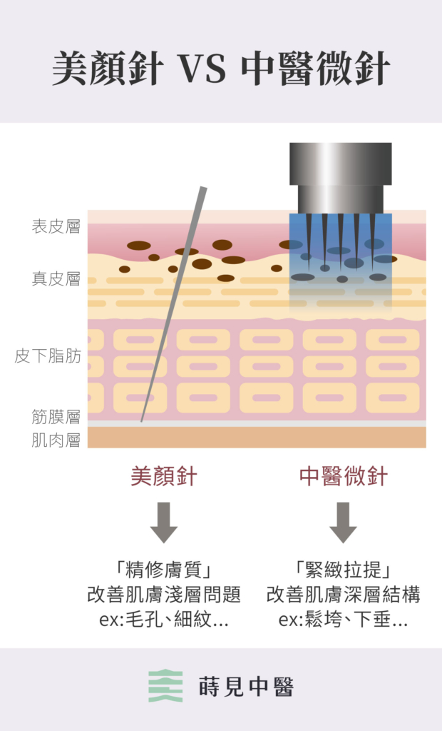 美顏針與中醫微針的比較