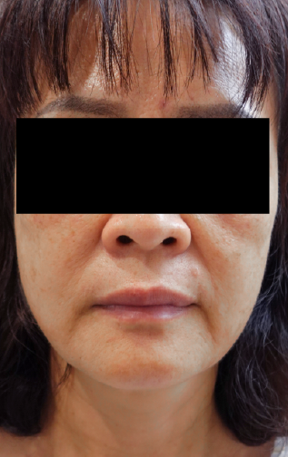 美顏針案例-嘴邊肉Before