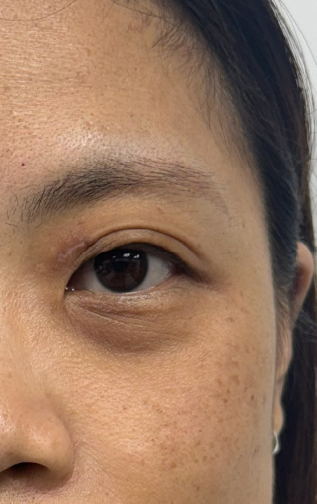 美顏針案例-眼周紋After