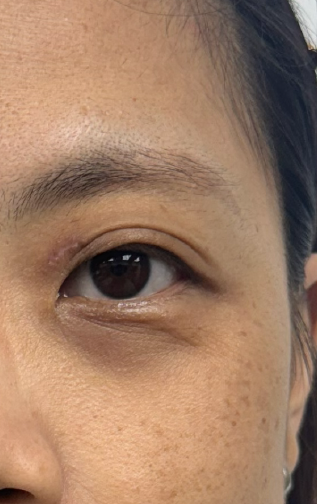 美顏針案例-眼周紋Before