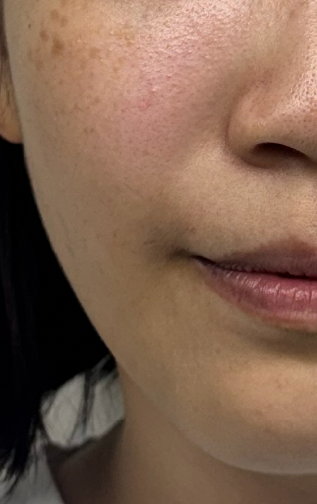 美顏針案例-蘋果肌After