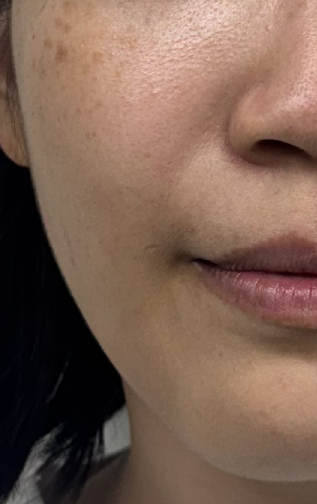 美顏針案例-蘋果肌Before