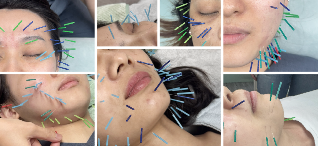 美顏針施作圖