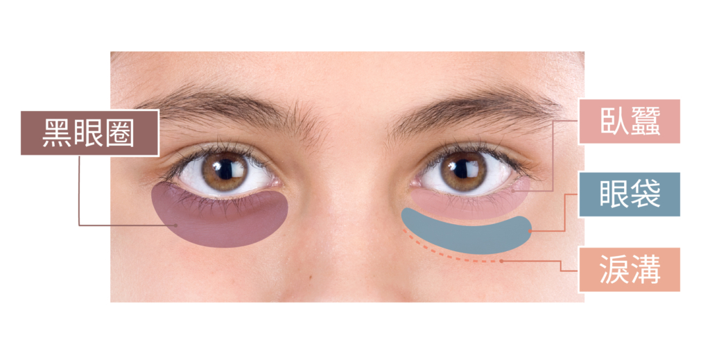 蒔見-眼周困擾
