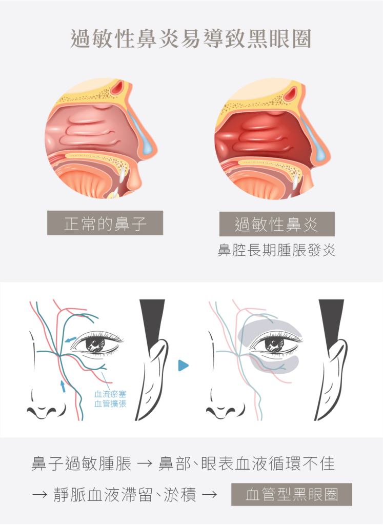 過敏性鼻炎易導致血管型黑眼圈