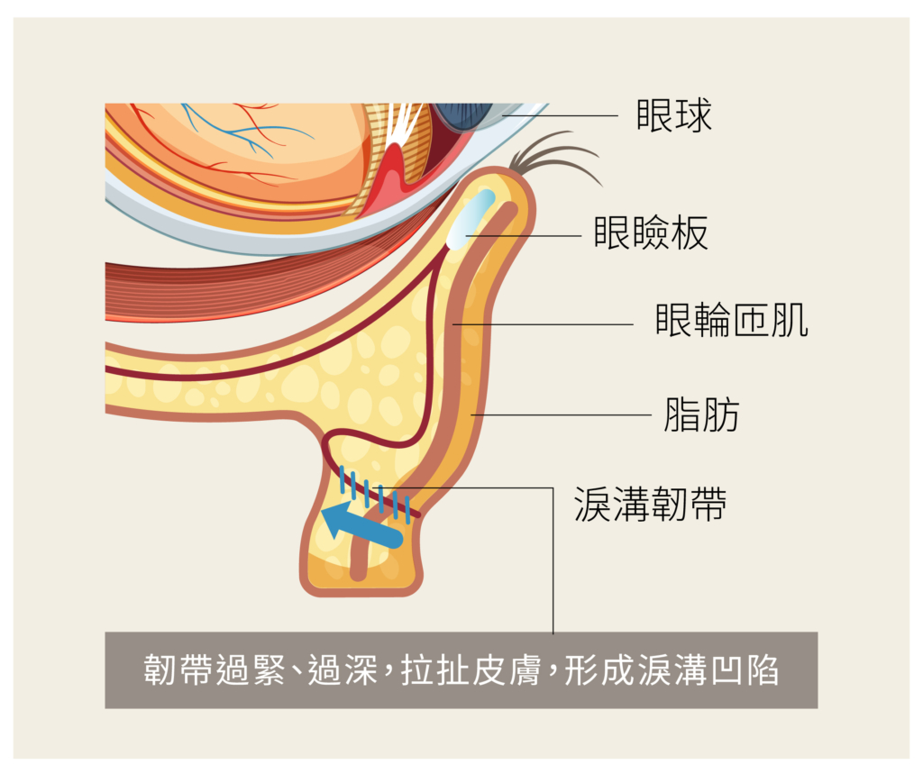 淚溝韌帶拉扯形成淚溝