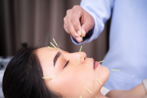 猛健樂臉部凹陷美顏針調理