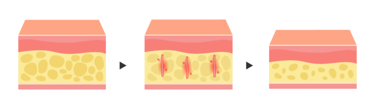 埋線減重治療原理