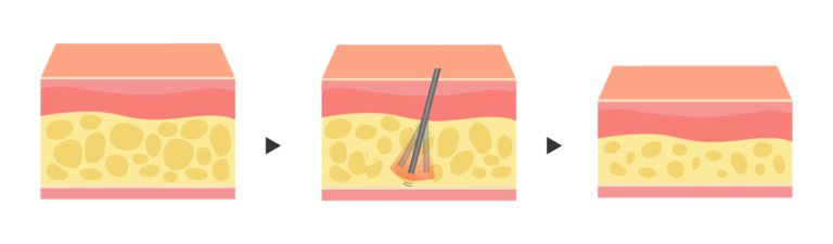 針刀減重治療原理